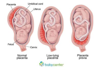 Placenta praevia: quand la malposition du placenta devient une complication de grossesse!