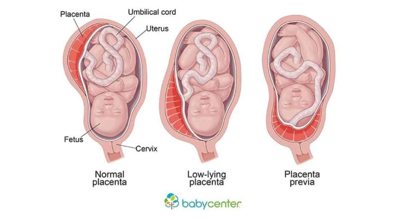 Placenta praevia: quand la malposition du placenta devient une complication de grossesse!
