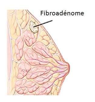 Le fibrome du sein: une maladie bénigne et fréquente chez la jeune ...