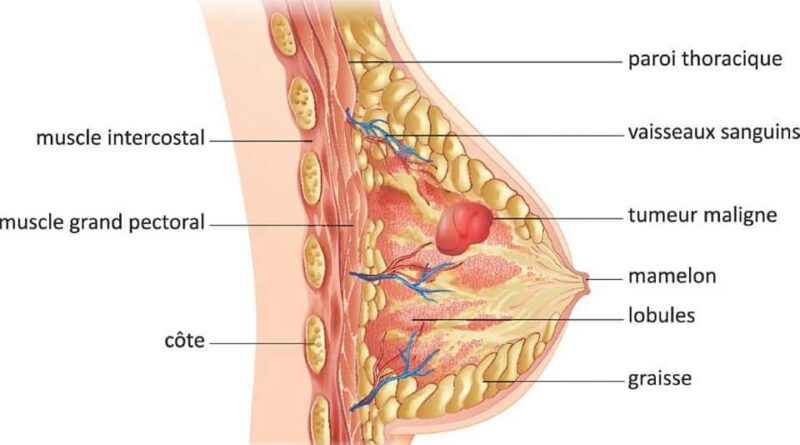 Cancer du sein: 1 femme sur 10 fera le cancer du sein au cours de sa vie ( GLOBOCAN)