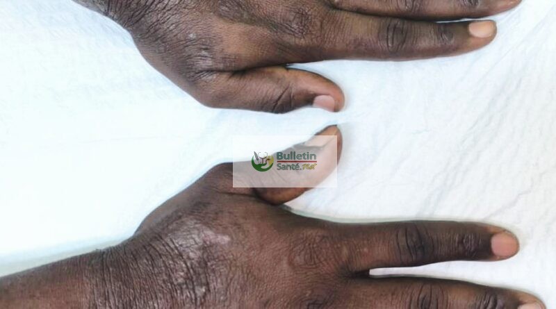 Eczéma professionnel : une maladie de la peau liée au travail Eczéma professionnel : une maladie de la peau liée au travail